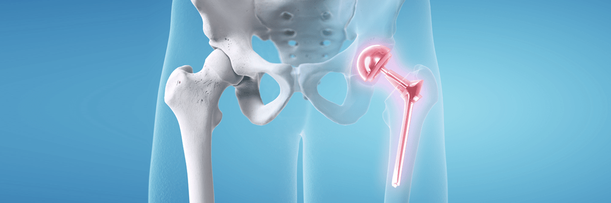 Total Hip Arthroplasty(THA)